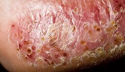 Dermatomikoza