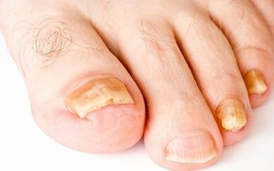 Foto simptomi glive za nohte