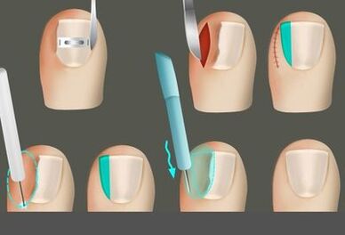 Odstranjevanje nohta v prisotnosti glive na nogah