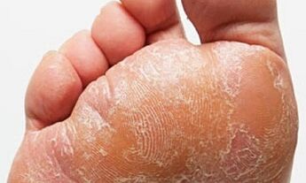 Znaki in simptomi glive na nogah