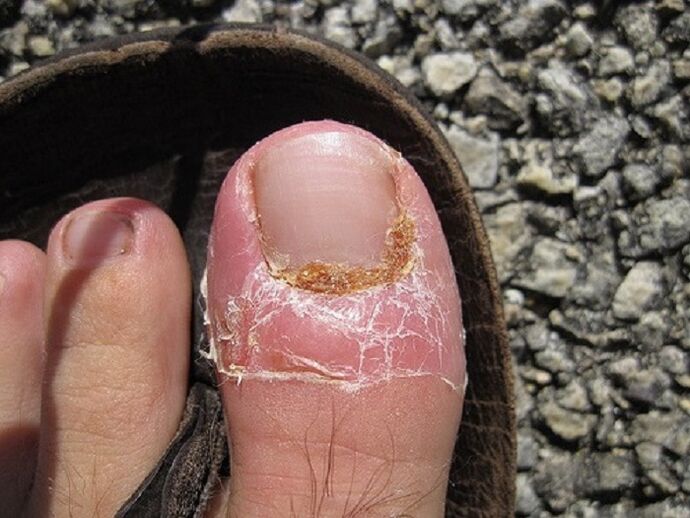 poškodbe nohtov in kože prstov na nogah zaradi glivične okužbe